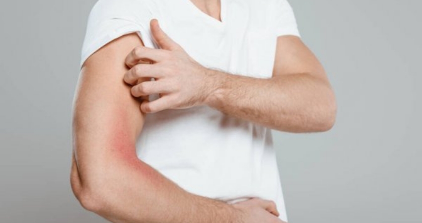 JAMA Dermatology publica dados com resultados do estudo sobre a superioridade de upadacitinib vs dupilumab em adultos com dermatite at&oacute;pica