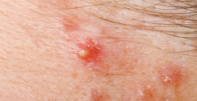 Pele: Infe&ccedil;&otilde;es bacterianas