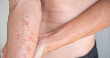 Estudo indica que dermatite at&oacute;pica diminui n&iacute;veis de alegria nos doentes